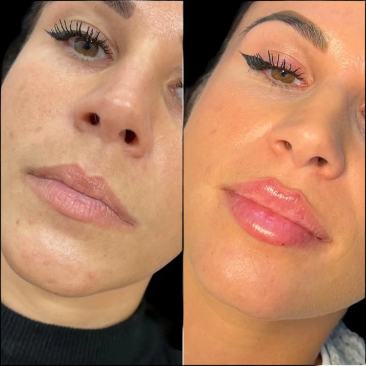 Can Juvederm Be Combined with Other Fillers? Answers from the Best Plastic Surgeon in dubai