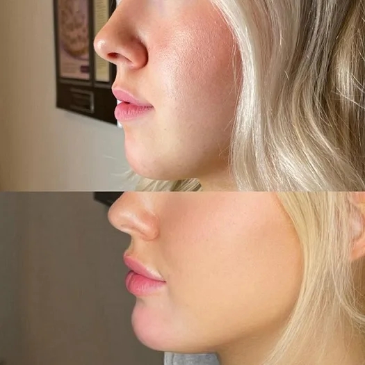 Smooth and Sculpt Your Chin with Chin Fillers Treatment in Dubai