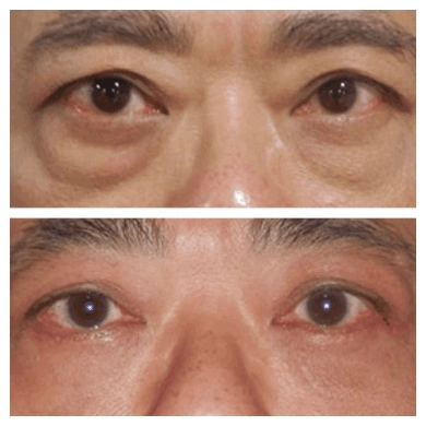 How the Best Eye bag removal Surgeon in dubai Tailors Treatment to Your Needs