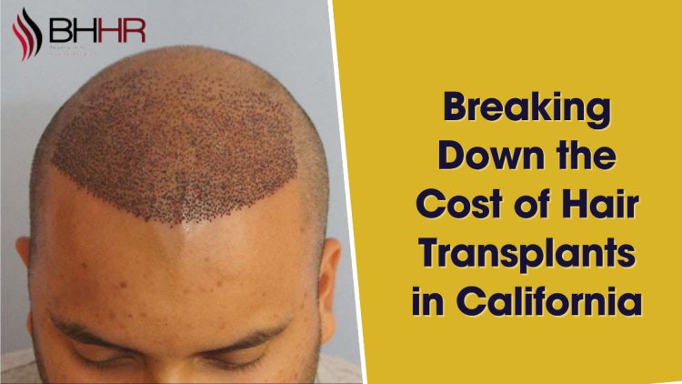 Breaking Down the Cost of Hair Transplants in California