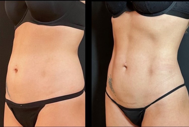 Tummy Tuck  Raleigh North Carolina