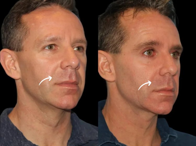 Understanding the Risks of Sculptra: Expert Insights from the Best Plastic Surgeons in dubai